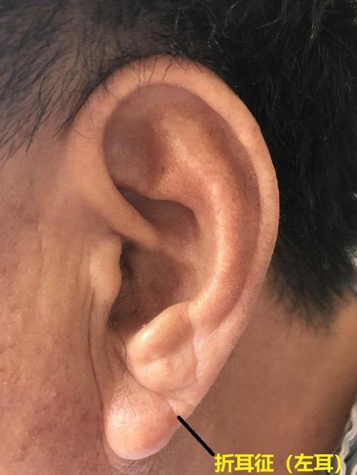耳垂有折痕和冠心病有关系吗