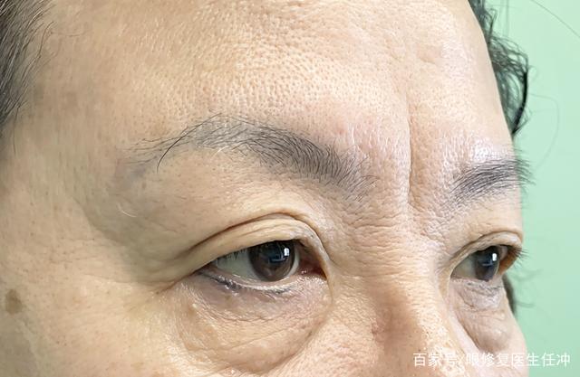 40岁 是川字纹(又称眉间纹)的高发期,多是由于皱眉肌,降眉肌,还有眼轮